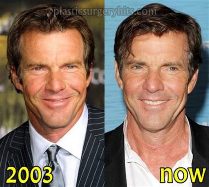 Exploring The Transformation: Dennis Quaid's Face Lift Journey