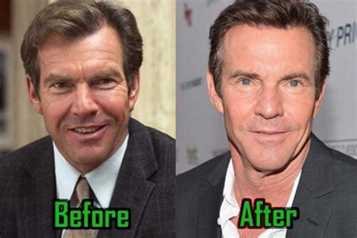 Unveiling The Truth: Dennis Quaid's Journey Through Plastic Surgery