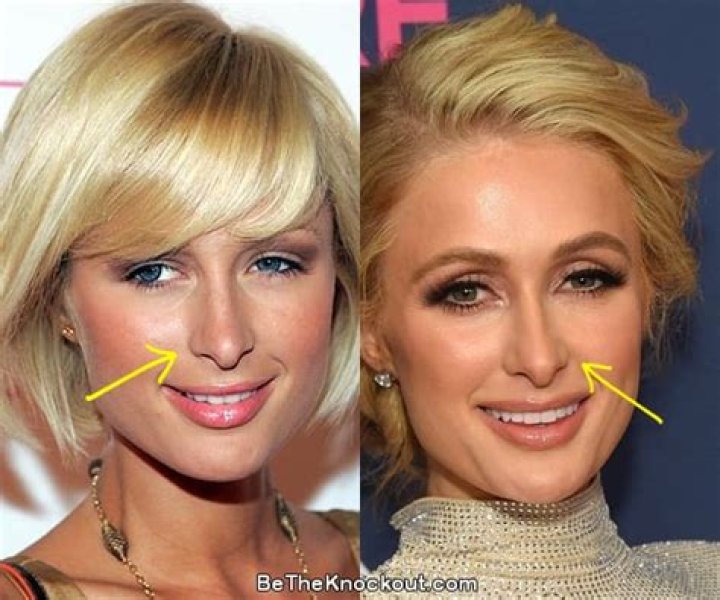 The Truth Behind Paris Hilton's Nose: Has She Had Surgery?