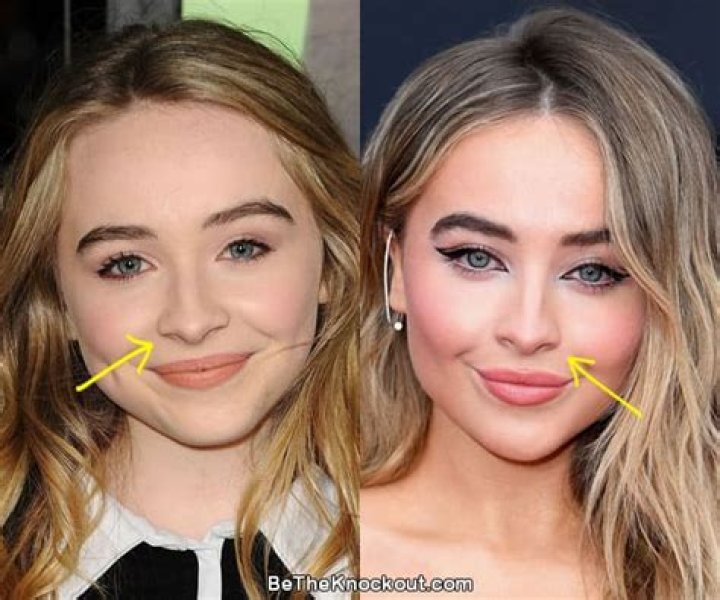 Did Sabrina Carpenter's Surgery Really Happen?: Uncovering The Truth