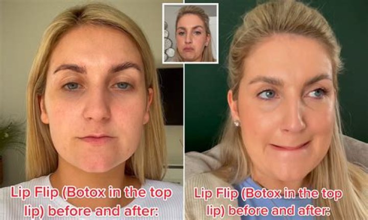 When Beauty Takes A Turn: Gone Wrong Botox Upper Lip Flip Before And After