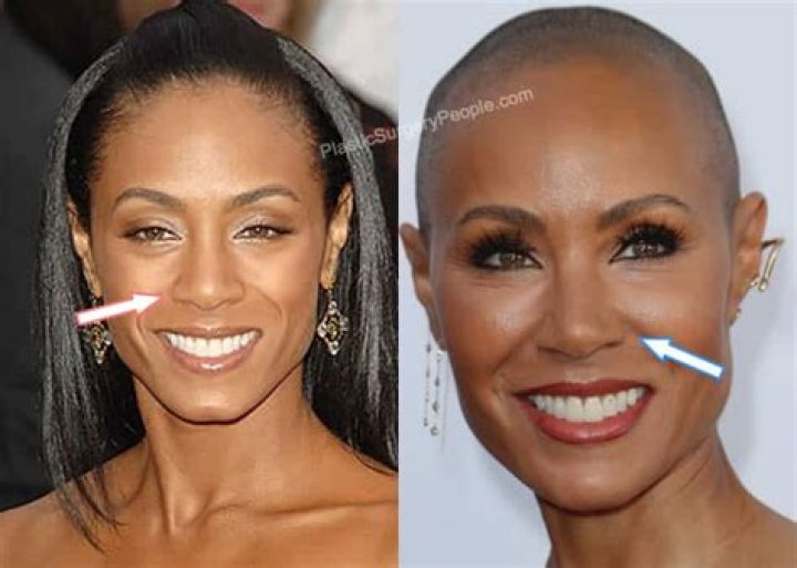 Jada Pinkett's Rhinoplasty: Transformation And Controversy