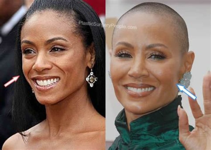 Jada Pinkett Smith's Transformation: Examining The Rumors Of Cheek Implants