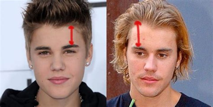 The Evolution Of Justin Bieber's Hairline: From Boyish Charm To Mature Elegance