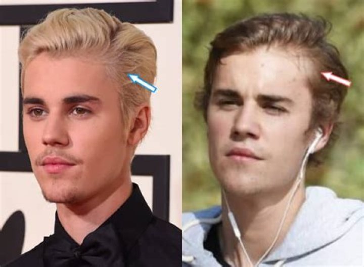 Justin Bieber's Shocking Hair Loss: Causes And Treatments