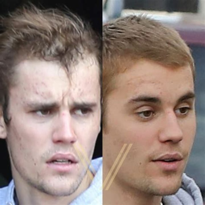 All About Justin Bieber's Hair Transplant Journey
