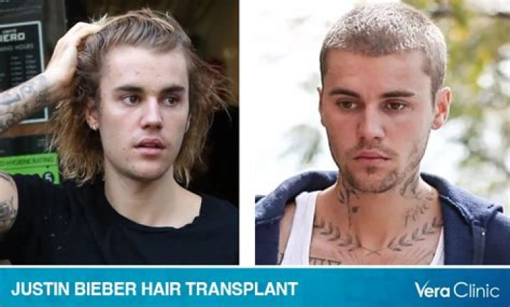Justin Bieber's Hair Loss: The Causes, Treatment, And Impact