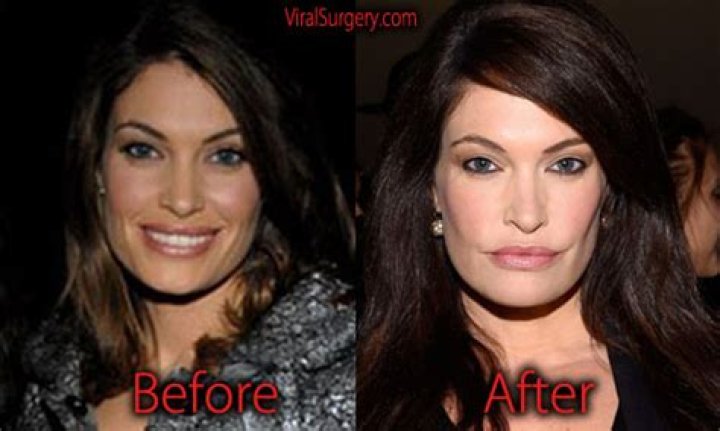 Unveiling Kimberly Guilfoyle's Nose: A Closer Look