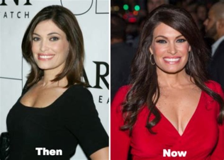 Unveiling The Transformation: Kimberly Guilfoyle Plastic Surgery Photos