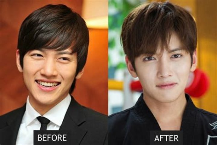 Korean Actors Surgery Before And After: The Transformative Journey