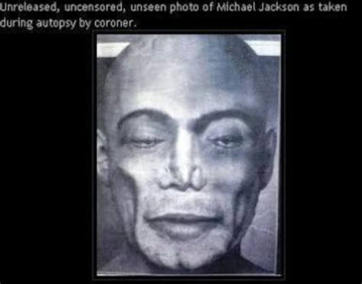 Expert Findings: Michael Jackson Autopsy Results Uncovered