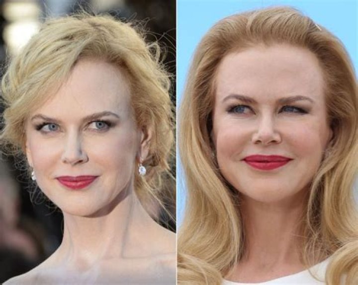 The Transformation Of Nicole Kidman: Exploring The Impact Of Plastic Surgery