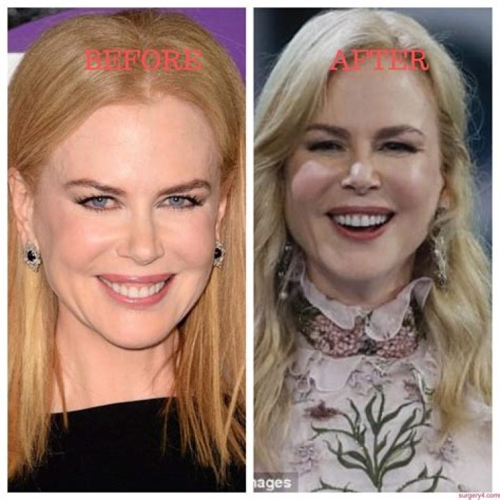 The Complete Transformation Of Nicole Kidman: Before And After Surgery