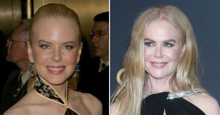 Nicole Kidman's Botox: A Candid Look At Its Effects