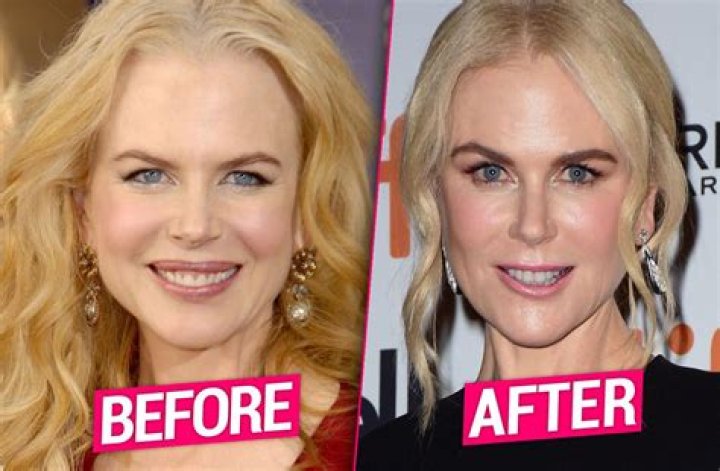 Unveiling Nicole Kidman's Facelift: A Transformative Journey