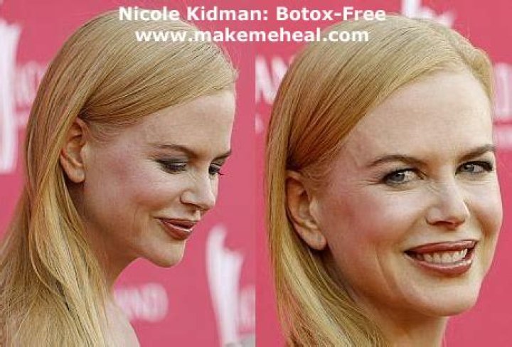 Nicole Kidman's Lips: Secrets Of Her Enchanting Pout