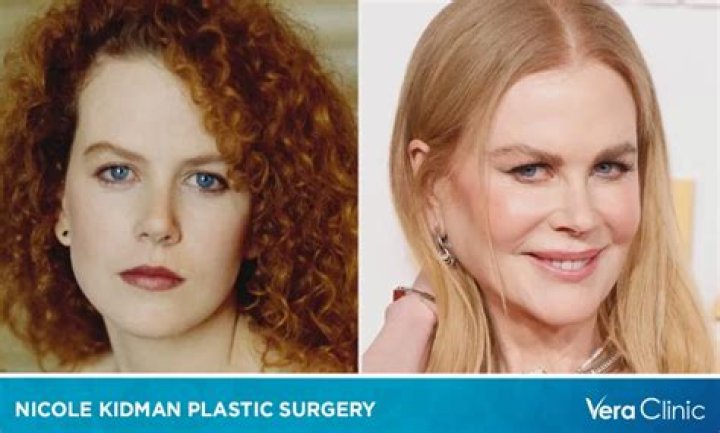The Truth About Nicole Kidman's Plastic Surgery