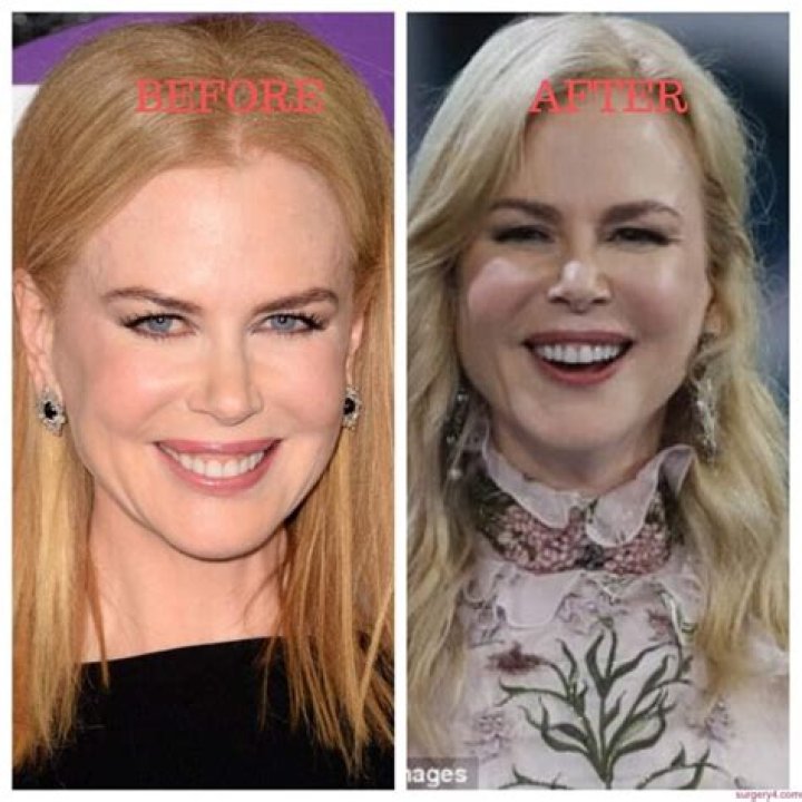 The Latest Scoop: Nicole Kidman's 2024 Plastic Surgery Journey