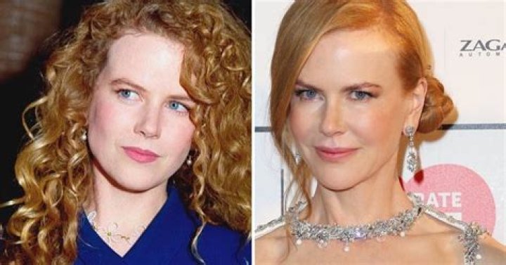 Uncovering Nicole Kidman's Surgery Secrets In 'The Undoing'