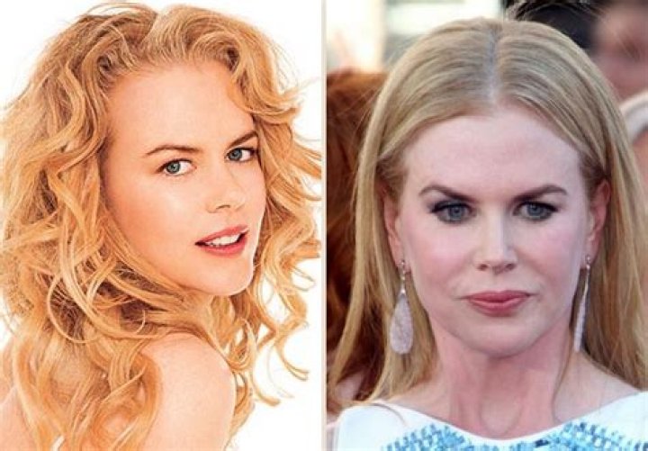 The Truth About Nicole Kidman's Surgeries: The Complete Guide