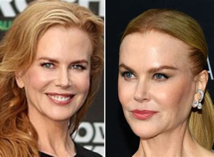 Nicole Kidman's Plastic Surgery Journey: A Transformation Through Time