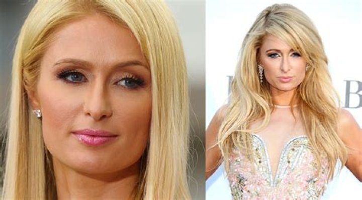 Paris Hiltons Transformation: Before And After Rhinoplasty