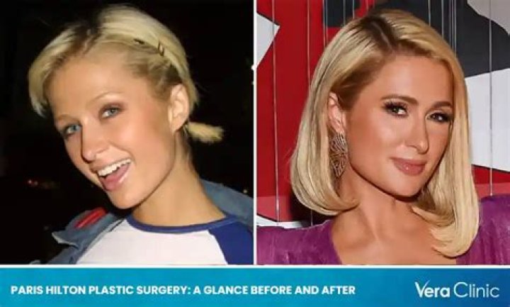 Paris Hilton's Cosmetic Enhancements: A Detailed Guide To Her Fillers