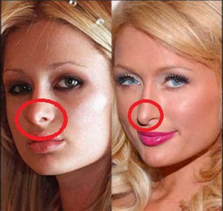 Paris Hilton's Nose: The Ultimate Guide To Her Changing Appearance