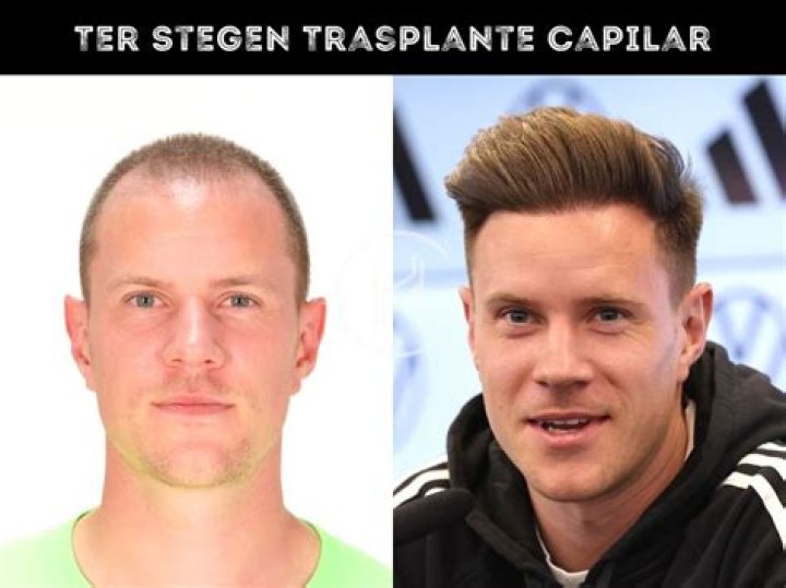Unveiling The Enigma Of Ter Stegen Pelo